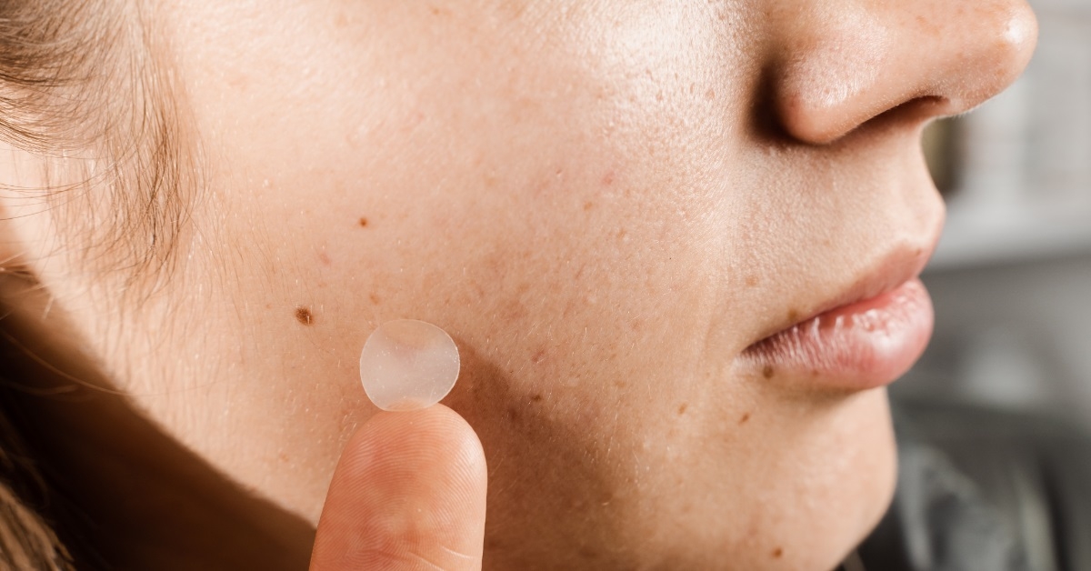 woman using acne patch on face