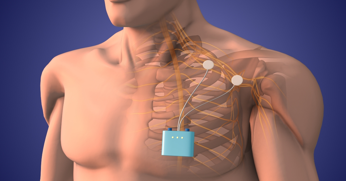Peripheral nerve stimulation therapy in shoulder area