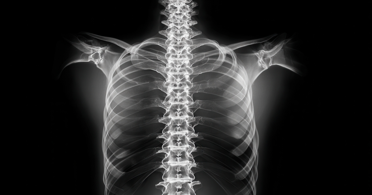 spine straightening and intact disc spaces