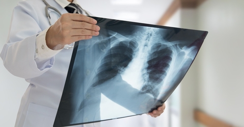 doctor examining lung x-ray film